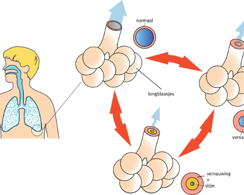 Astma in de keten Longzorg (voor praktijken die deze nog niet eerder hebben bijgewoond)